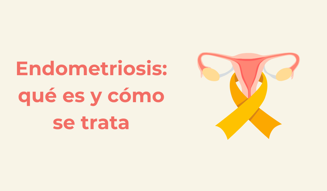 Endometriosis: qué es y cómo se trata